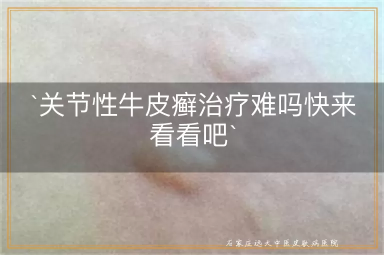 关节性牛皮癣治疗难吗快来看看吧