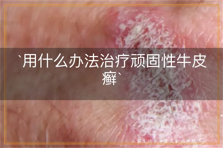 用什么办法治疗顽固性牛皮癣