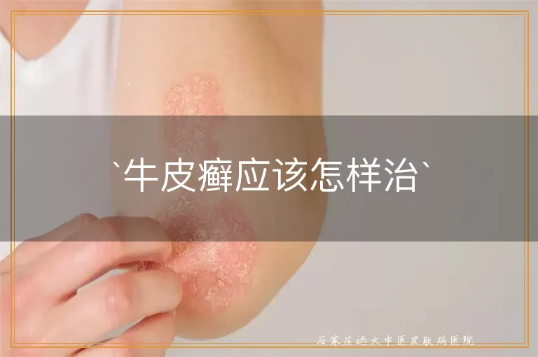 牛皮癣应该怎样治