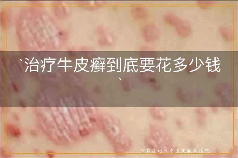 治疗牛皮癣到底要花多少钱