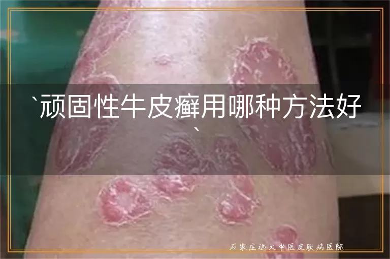 顽固性牛皮癣用哪种方法好