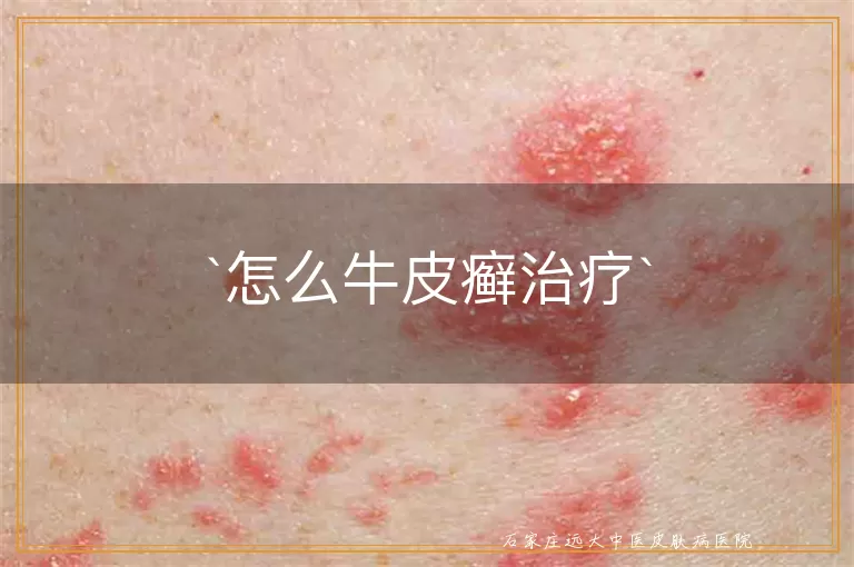 怎么牛皮癣治疗
