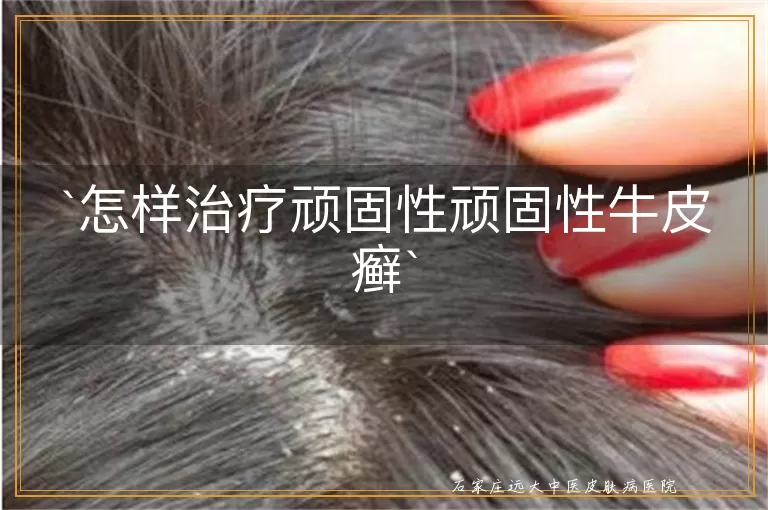 怎样治疗顽固性顽固性牛皮癣