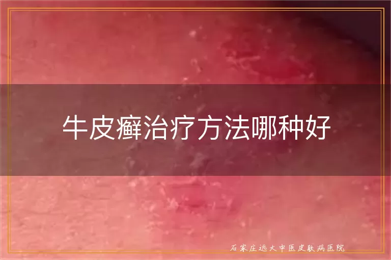 牛皮癣治疗方法哪种好