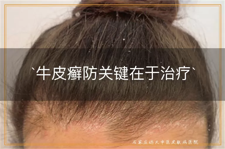 牛皮癣防关键在于治疗
