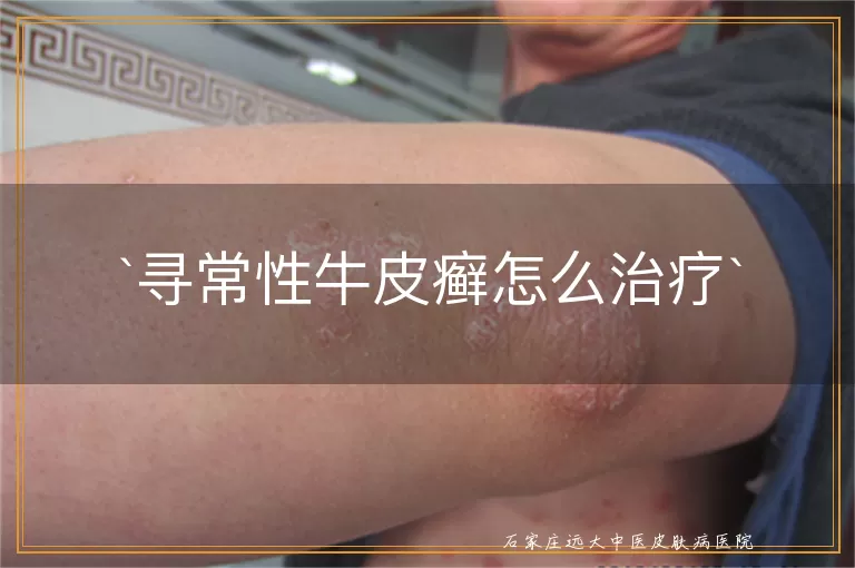 寻常性牛皮癣怎么治疗