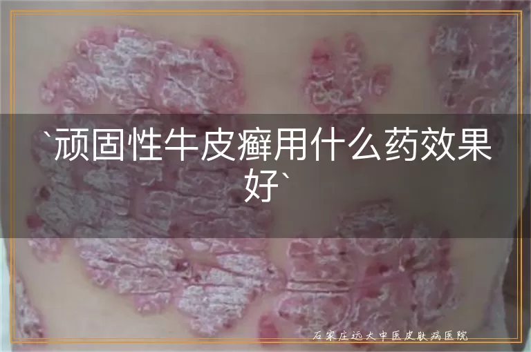 顽固性牛皮癣用什么药效果好