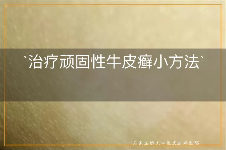 治疗顽固性牛皮癣小方法