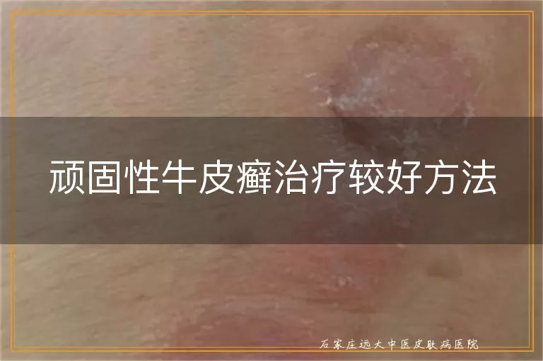 顽固性牛皮癣治疗较好方法