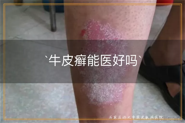 牛皮癣能医好吗