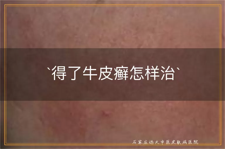 得了牛皮癣怎样治