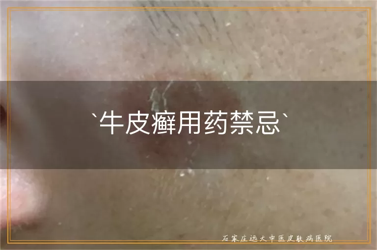牛皮癣用药禁忌