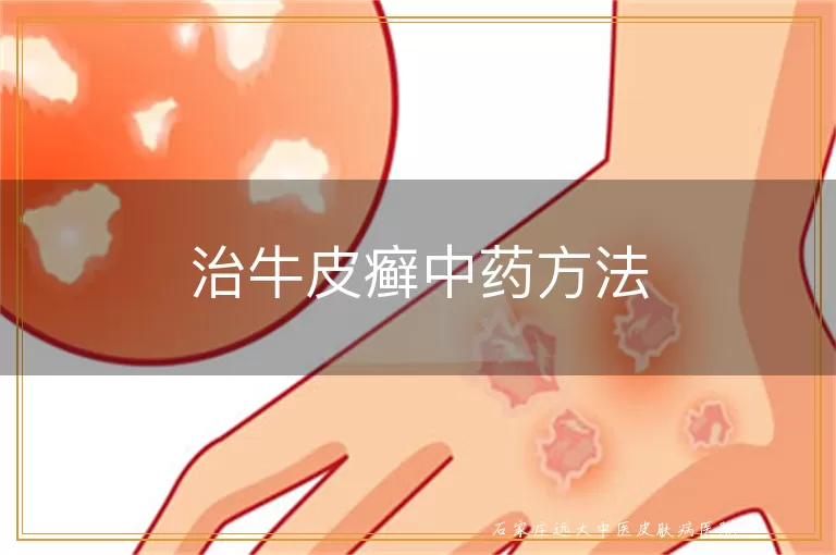 治牛皮癣中药方法