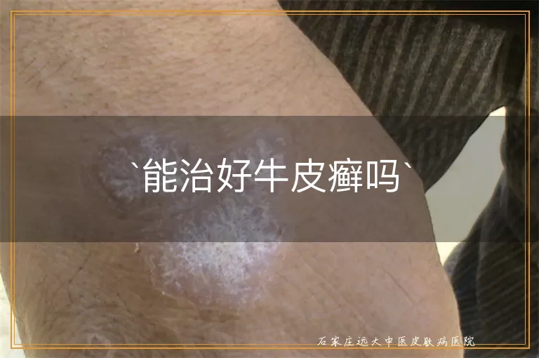 能治好牛皮癣吗