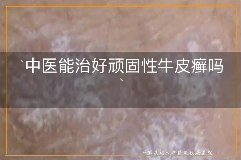 中医能治好顽固性牛皮癣吗