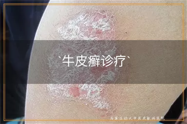 牛皮癣诊疗