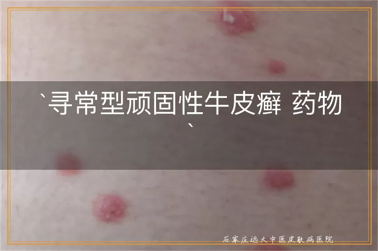 寻常型顽固性牛皮癣 药物