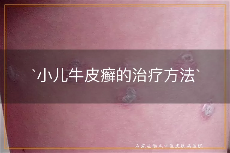 小儿牛皮癣的治疗方法