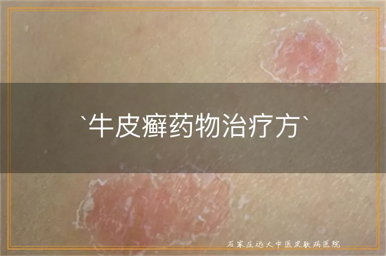 牛皮癣药物治疗方