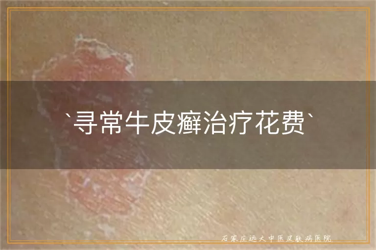 寻常牛皮癣治疗花费