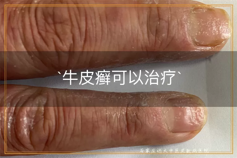 牛皮癣可以治疗