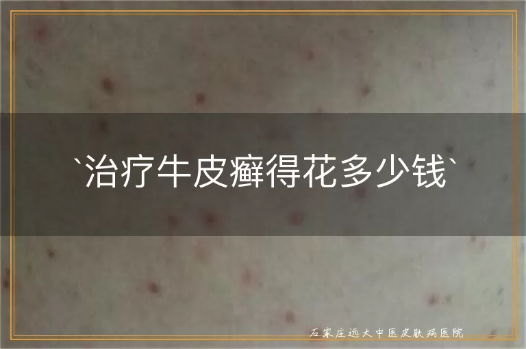 治疗牛皮癣得花多少钱