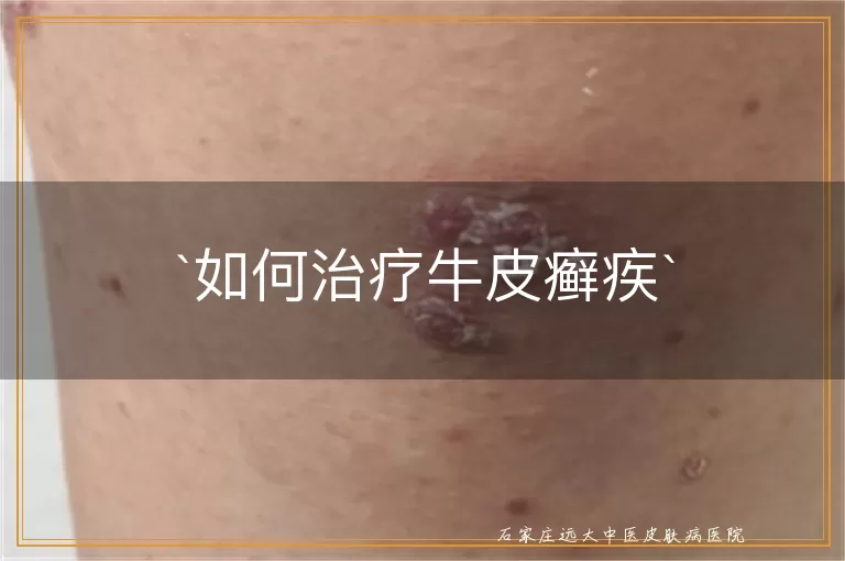 如何治疗牛皮癣疾