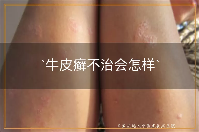 牛皮癣不治会怎样