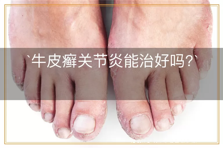 牛皮癣关节炎能治好吗?