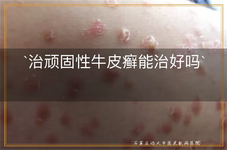 治顽固性牛皮癣能治好吗