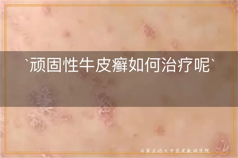 顽固性牛皮癣如何治疗呢