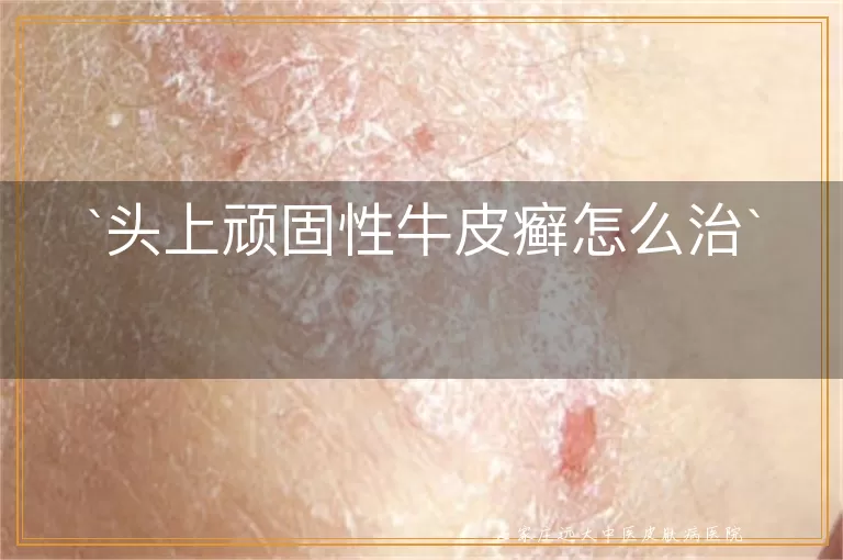 头上顽固性牛皮癣怎么治
