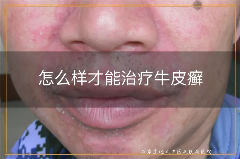 怎么样才能治疗牛皮癣