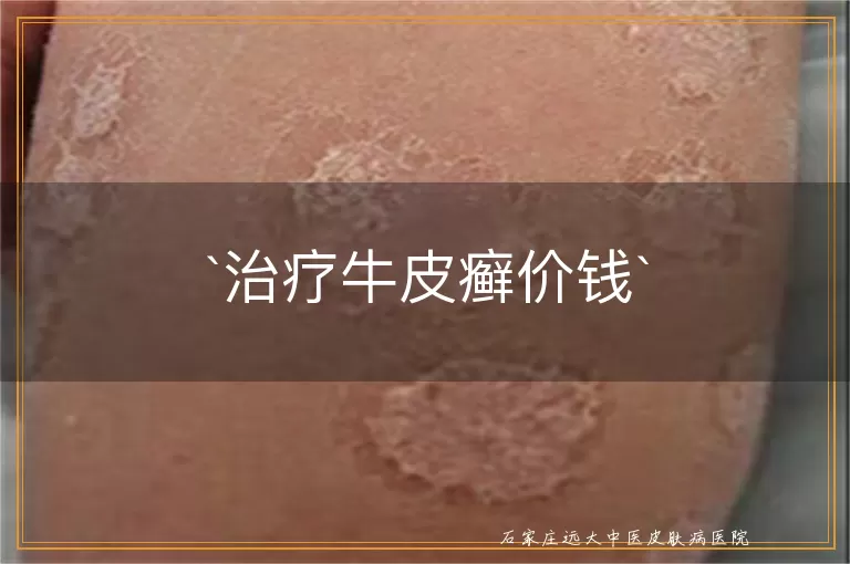 治疗牛皮癣价钱