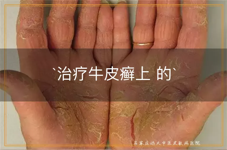 治疗牛皮癣上 的