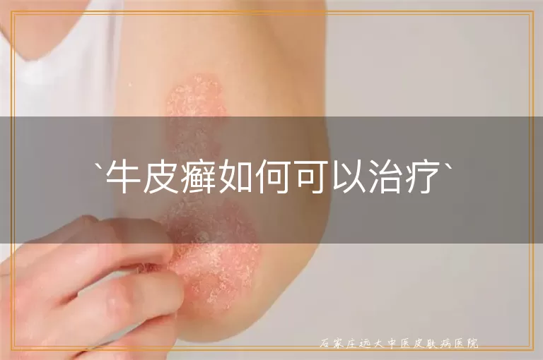 牛皮癣如何可以治疗
