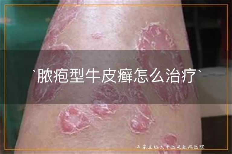 脓疱型牛皮癣怎么治疗