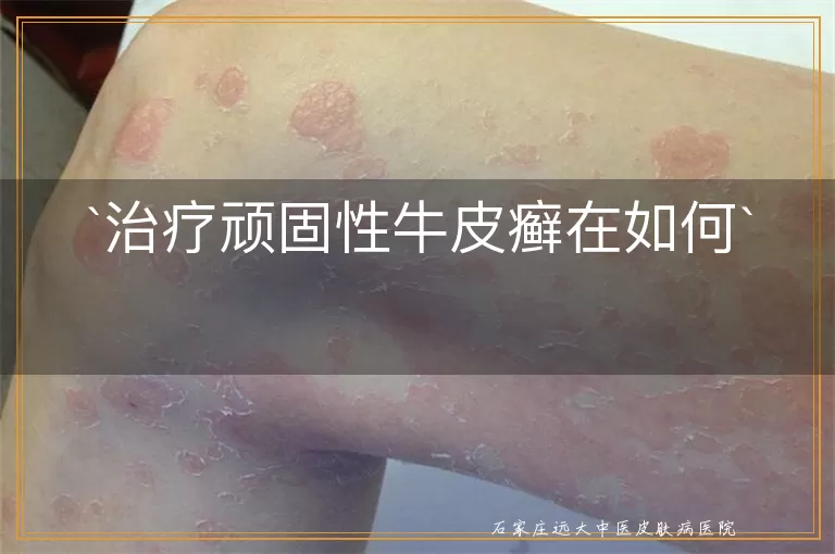 治疗顽固性牛皮癣在如何