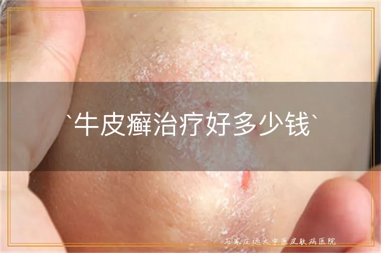 牛皮癣治疗好多少钱