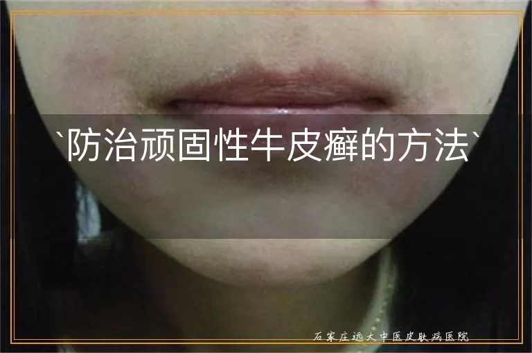 防治顽固性牛皮癣的方法