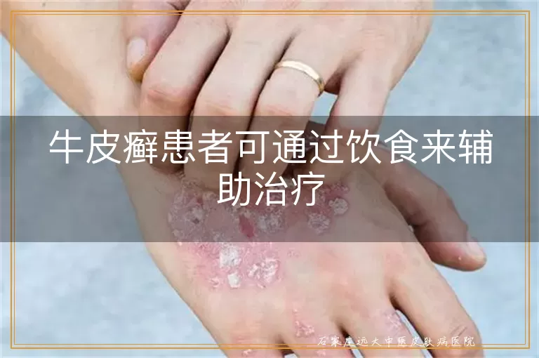 牛皮癣患者可通过饮食来辅助治疗