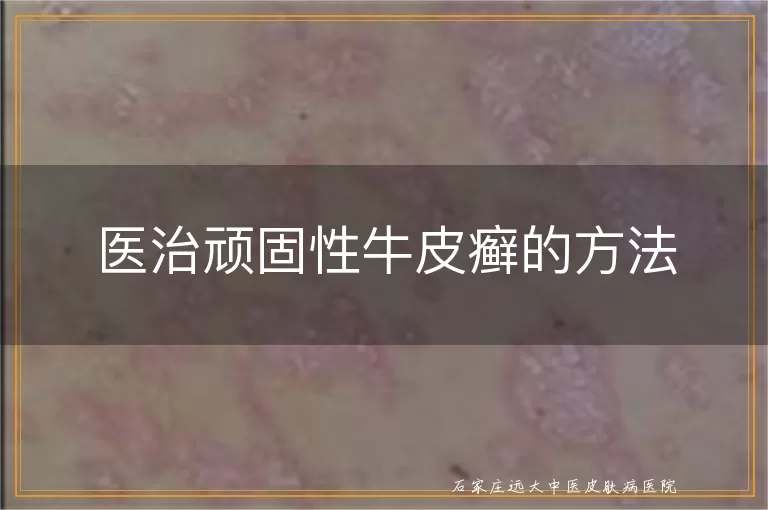 医治顽固性牛皮癣的方法