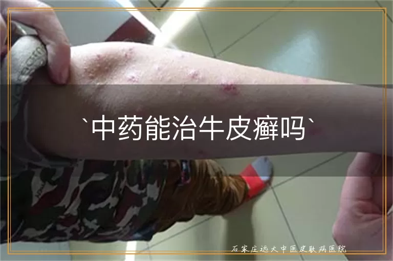 中药能治牛皮癣吗