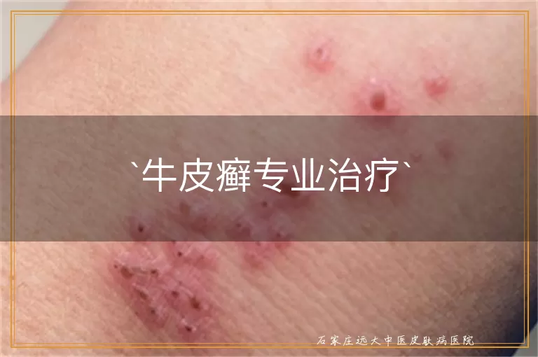 牛皮癣专业治疗