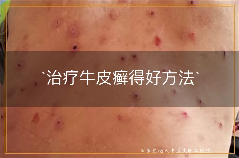 治疗牛皮癣得好方法