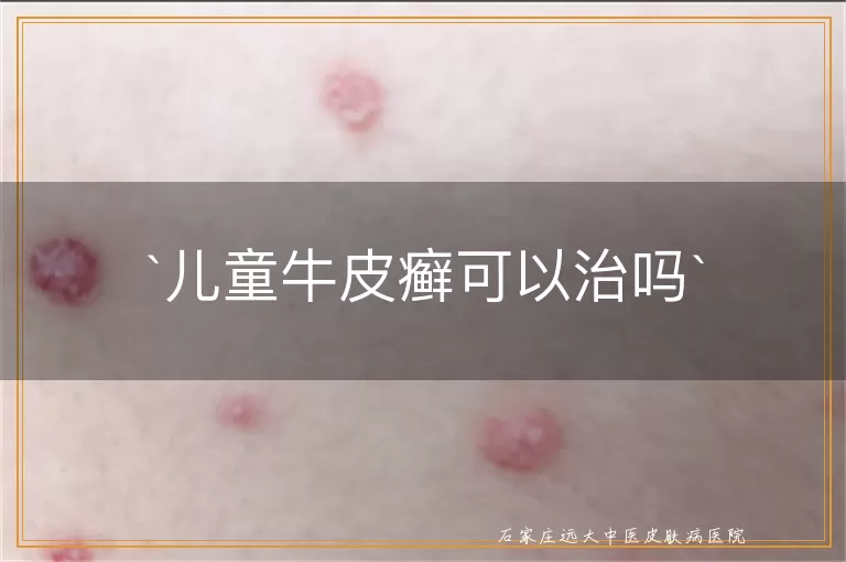 儿童牛皮癣可以治吗