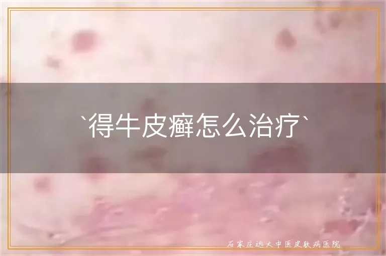 得牛皮癣怎么治疗