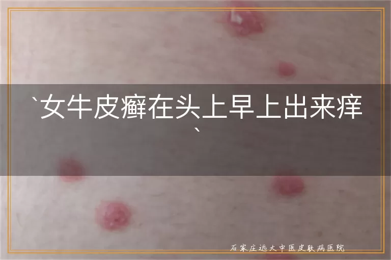 女牛皮癣在头上早上出来痒