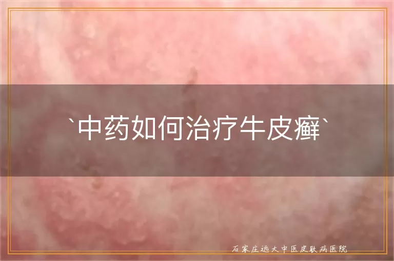 中药如何治疗牛皮癣