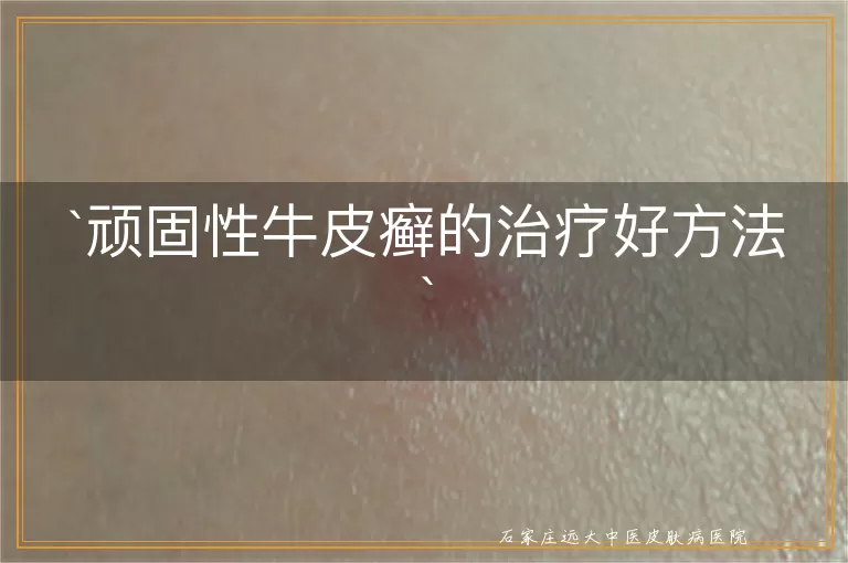 顽固性牛皮癣的治疗好方法